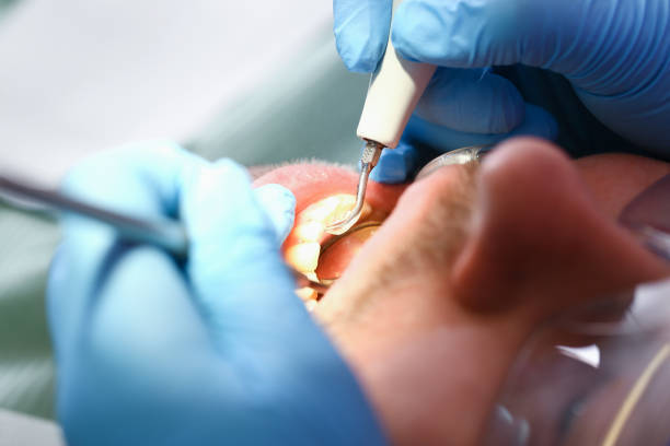 Best Emergency Root Canal Treatment in Painesville, OH