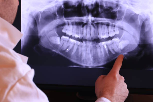 Best Emergency Wisdom Teeth Removal in Painesville, OH